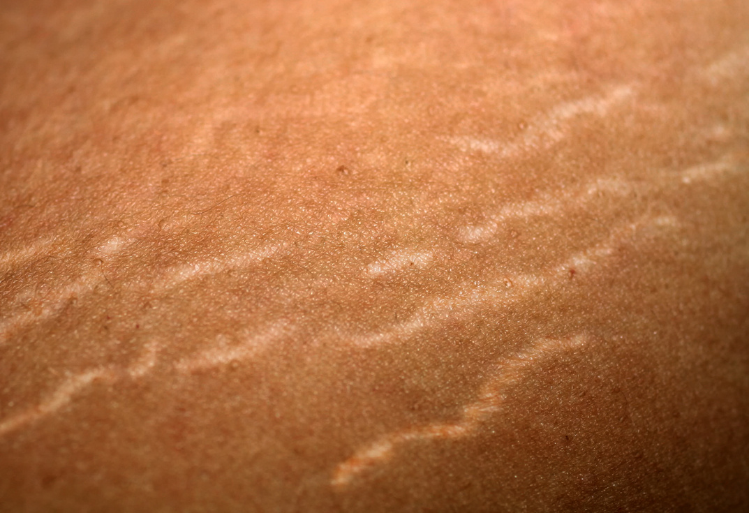 Stretch marks on the skin. Scars on the body. Stretch marks on legs. Cellulite.
